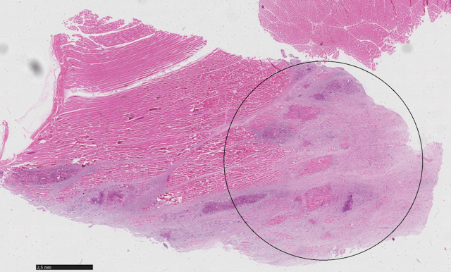 Abbildung 1: Reh. Histologische Untersuchung der Muskelfleischprobe: �bersicht Skelettmuskulatur mit Einwanderung von Entz�ndungszellen und Nekrose (Kreis)
